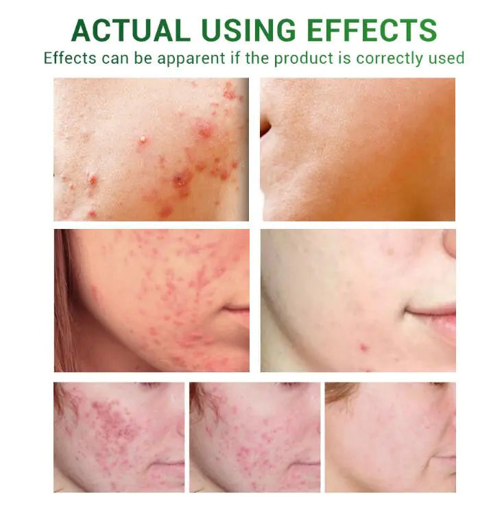 Esencia Reparadora Facial – Acne Treatment
